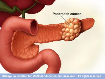 Pancreas Cancer
